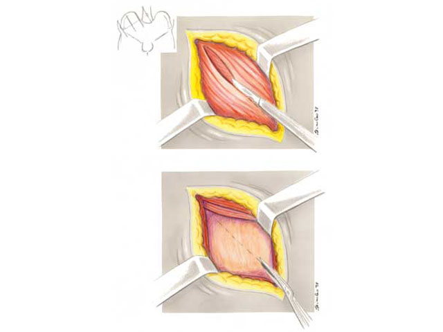 Appendicectomia